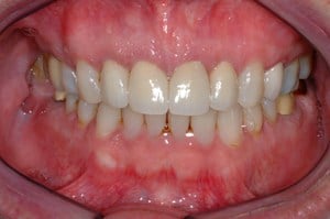 Hayden Family Dental Center, PLLC Smile Gallery Case 2 After Dental crowns treatment