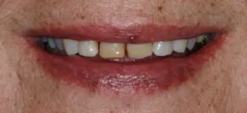 Hayden Family Dental Center, PLLC Smile Gallery Case 4 Before Photo