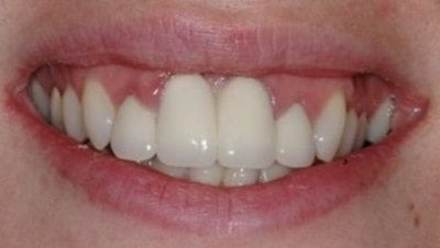 Hayden Family Dental Center, PLLC Smile Gallery Case 7 Before Photo