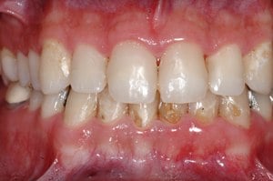 Hayden Family Dental Center, PLLC Smile Gallery Case 3 After Dental Bonding and fillings