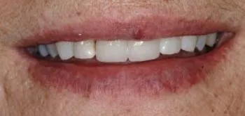 Hayden Family Dental Center, PLLC Smile Gallery Case 4 After 2 front crowns Photo