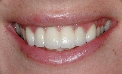 Hayden Family Dental Center, PLLC Smile Gallery Case 7 After Crown and Bridge Photo