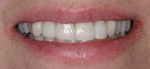 Hayden Family Dental Center, PLLC Smile Gallery Case 9 After Porcelain Veneers Photo