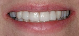 Hayden Family Dental Center, PLLC Smile Gallery Case 9 After Porcelain Veneers Photo