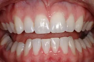 Hayden Family Dental Center, PLLC Case 6 Smile Gallery After Dental Bonding Photo