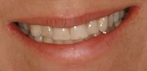 Hayden Family Dental Center, PLLC Smile Gallery Case 9 Before Photo