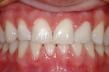 Hayden Family Dental Center, PLLC Smile Gallery Case 5 After Crown treatment to close gap