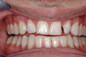 Hayden Family Dental Center, PLLC Smile Gallery Case 5 Before Photo