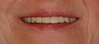 Hayden Family Dental Center, PLLC Dentures Case 1 After Dentures treatment