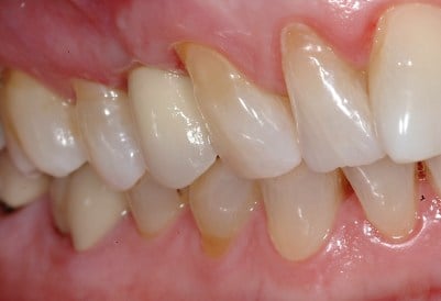 Hayden Family Dental Center, PLLC Smile Gallery Case 12 After Dental Implants Photo