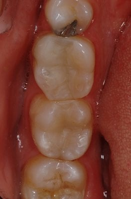 Hayden Family Dental Center, PLLC Smile Gallery Case 11 After Tooth colored fillings Photo