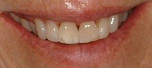 Online Smile Gallery, before Porcelain Veneers
