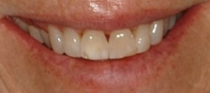 Online Smile Gallery, before Porcelain Veneers