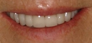 Online Smile Gallery, after Porcelain Veneers