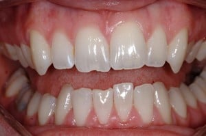 Hayden Family Dental Center, PLLC Case 6 Smile Gallery Before Photo