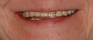 Hayden Family Dental Center, PLLC Dentures Case 1 Before Photo