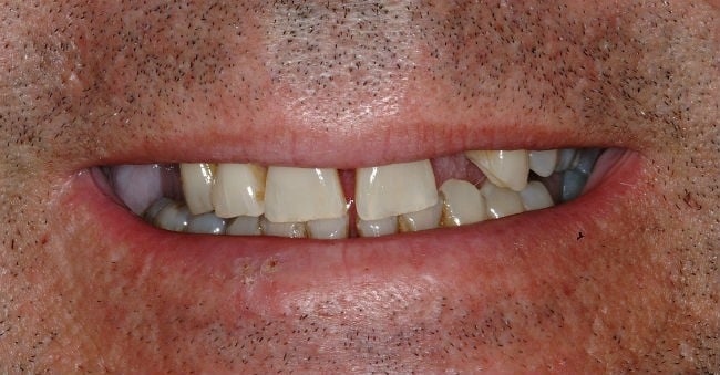 Hayden Family Dental Center, PLLC Smile Gallery Case 8 Before Photo