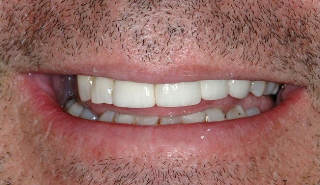 Hayden Family Dental Center, PLLC Smile Gallery Case 8 After Crowns and Bridge Photo
