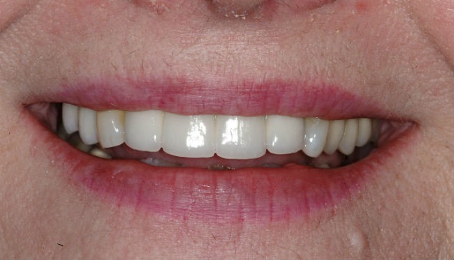 Hayden Family Dental Center, PLLC Smile Gallery Case 13 After Dental Implant Photo