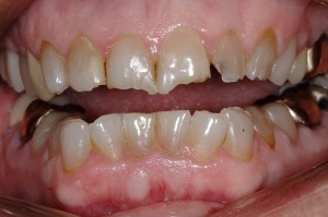 Online Smile Gallery, before dental crowns treatment