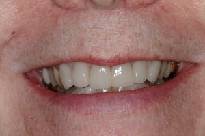 Online Smile Gallery, after dental crowns treatment