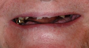 Hayden Family Dental Center, PLLC Case 2 Before Dentures 