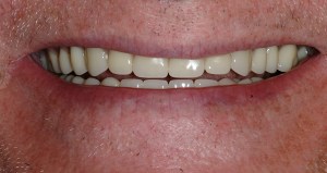 Hayden Family Dental Center, PLLC Smile Gallery Case 2 After Dentures